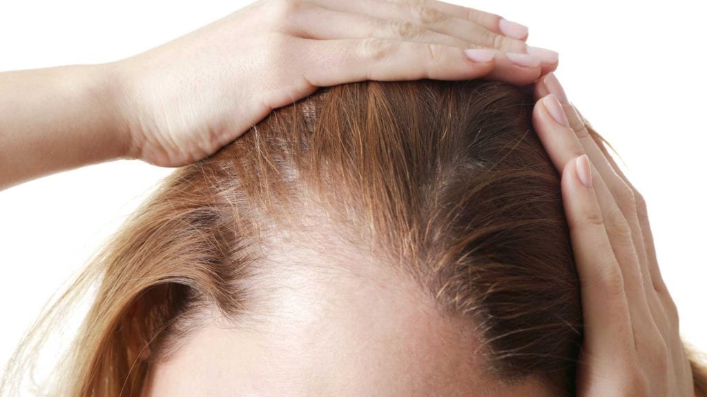 Woman showing hair loss near hairline