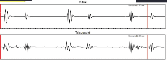 Mitral Graph With B Complex