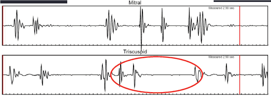 Mitral Graph