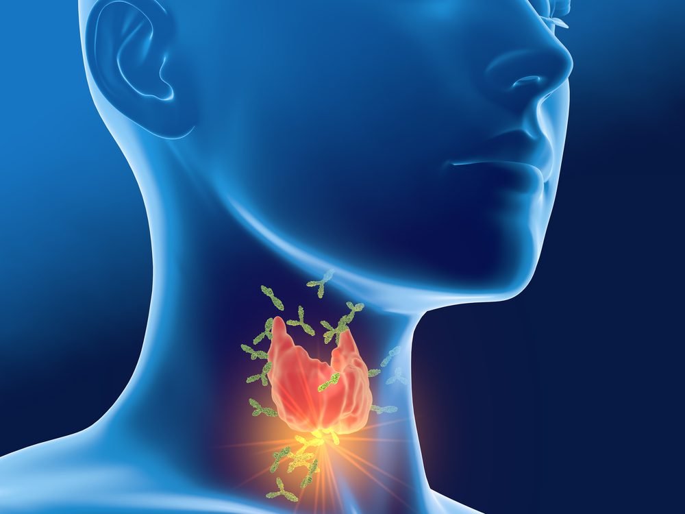 Antibodies attacking thyroid gland of a woman,  Autoimmune thyro