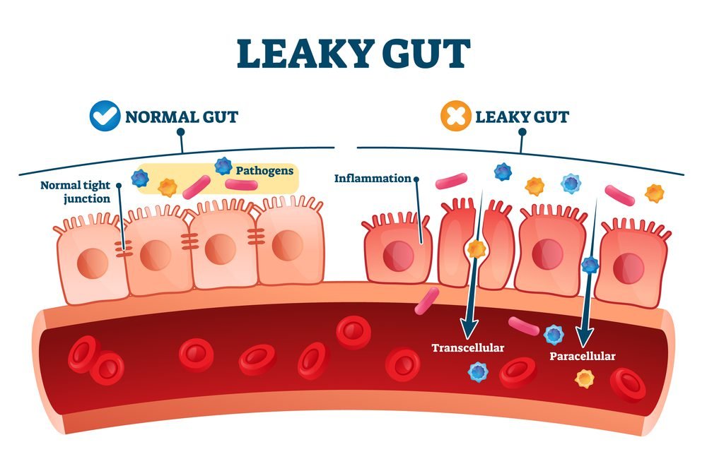 How To Heal A Leaky Gut Without Pharmaceutical Drugs