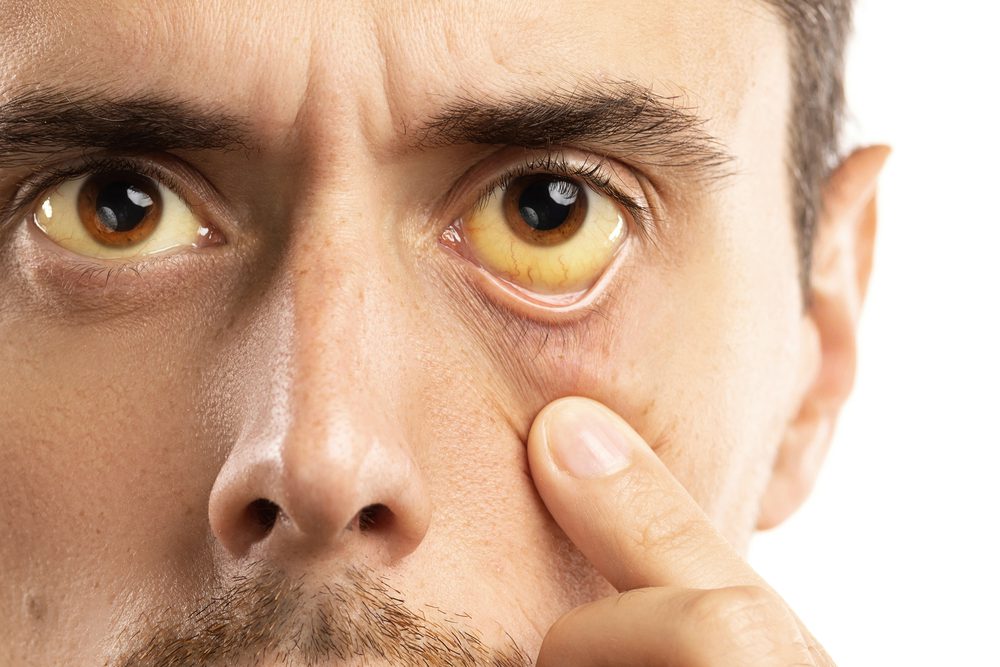 Is Yellow Skin Around Eyes Linked to Thyroid?