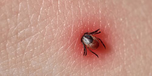 Close-up of a tick attached to reddened human skin, showing early signs of Lyme disease.