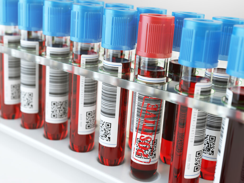 Blood sample vials with barcode labels in a laboratory rack, one marked positive for autoimmune disease testing